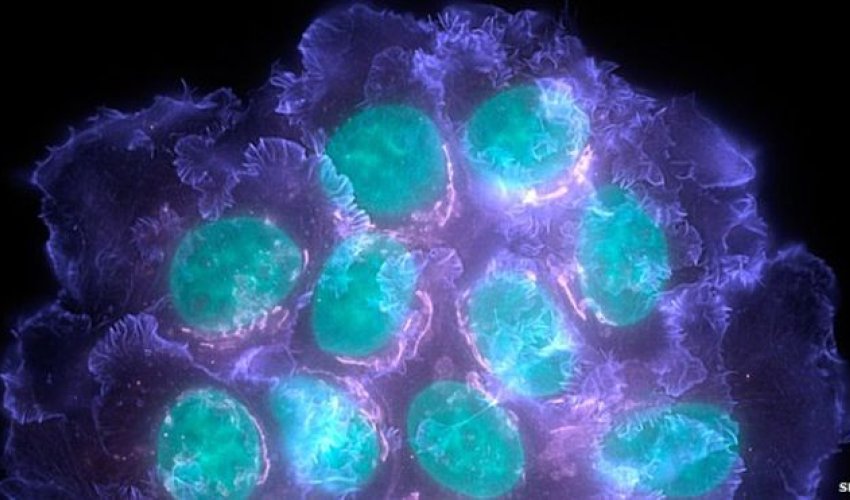Cheap drugs cut breast cancer deaths by 18%