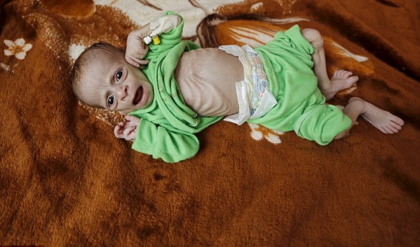 Heartbreaking images reveal the human face of hunger in Yemen