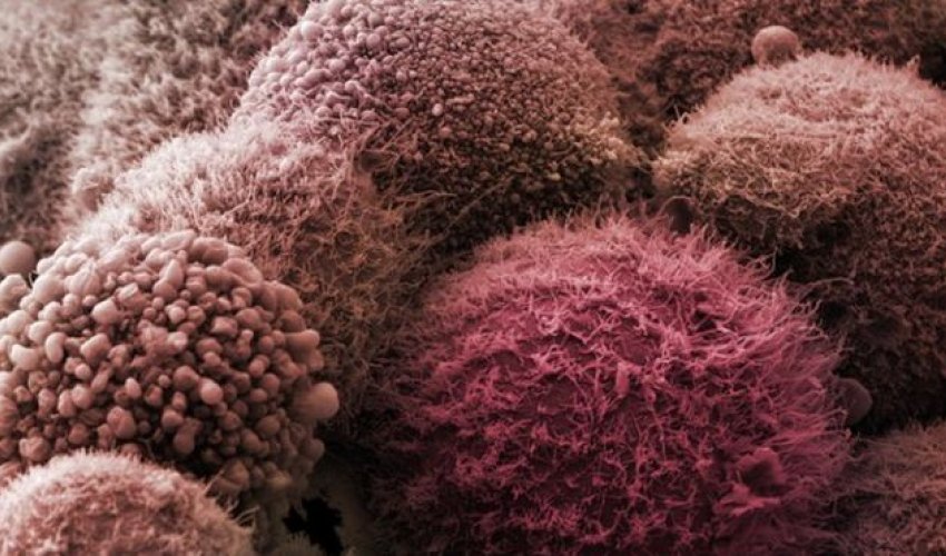 Pancreatic cancer urine test hope