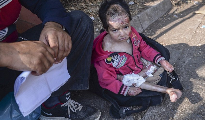 Parents flee Syria with their badly burned little girl