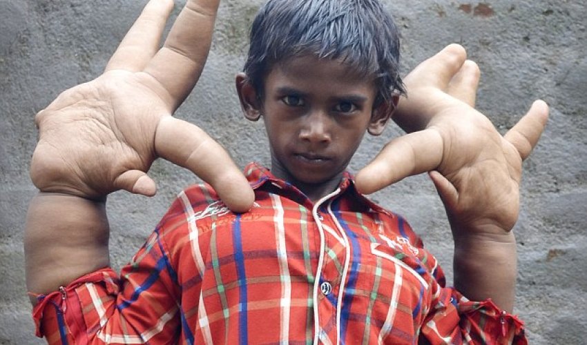 Hope for the boy with the world's biggest hands