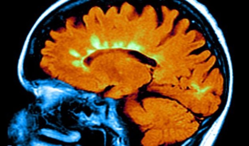 Low vitamin-D genes linked to MS