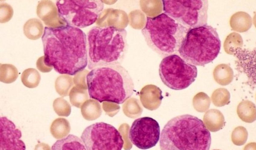 Diabetes drug may help in leukaemia