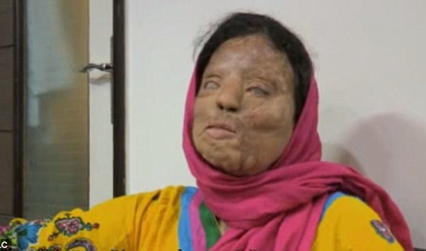 'It felt like I was being burned alive'