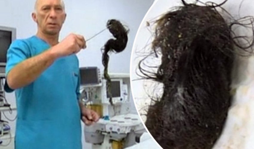 Stunned surgeons remove massive hairball from girl's stomach Stunned surgeons remove massive hairball from girl's stomach