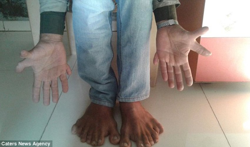 Indian carpenter with world record 28 fingers and toes Indian carpenter with world record 28 fingers and toes