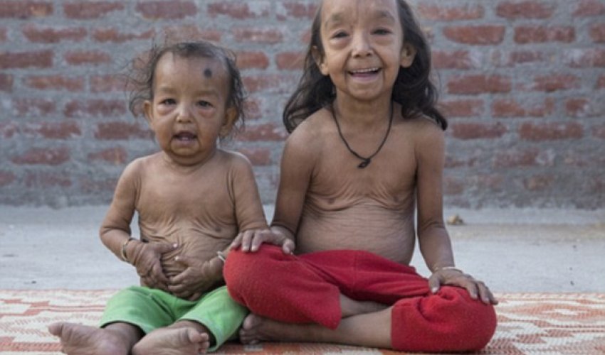 The extraordinary 'Benjamin Button' children