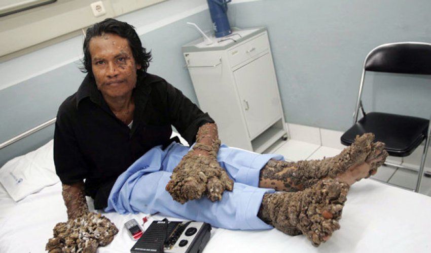 Man who suffered from limbs like TREE TRUNKS dies