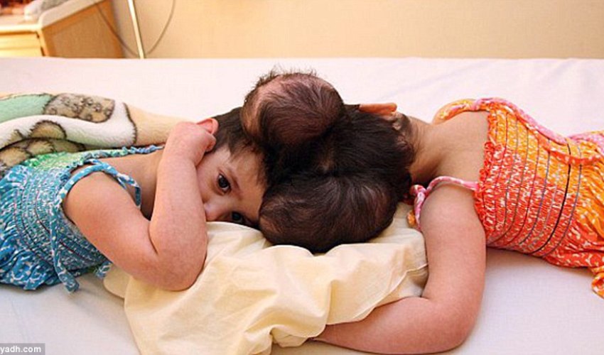 Twin four-year-old girls joined at the head are successfully separated Twin four-year-old girls joined at the head are successfully separated