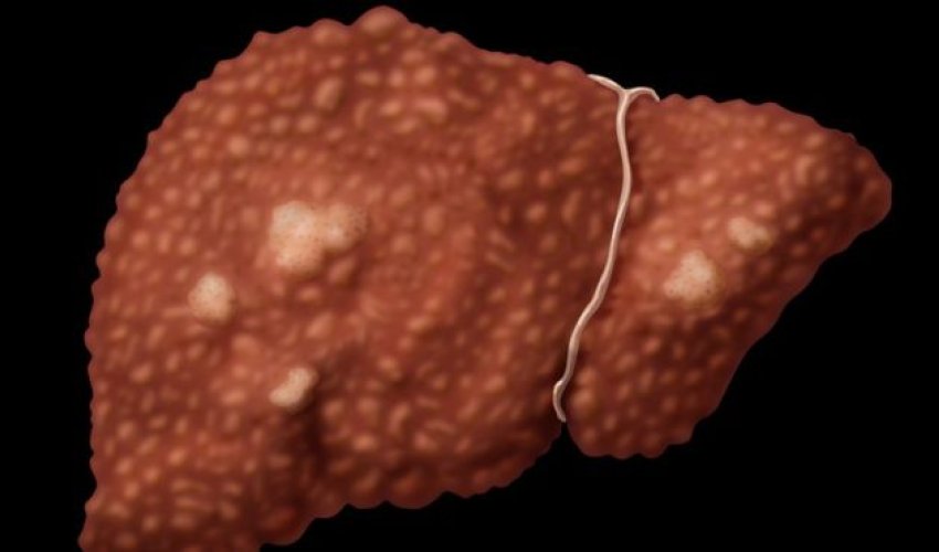 Viral hepatitis 'kills as many as Aids or TB'
