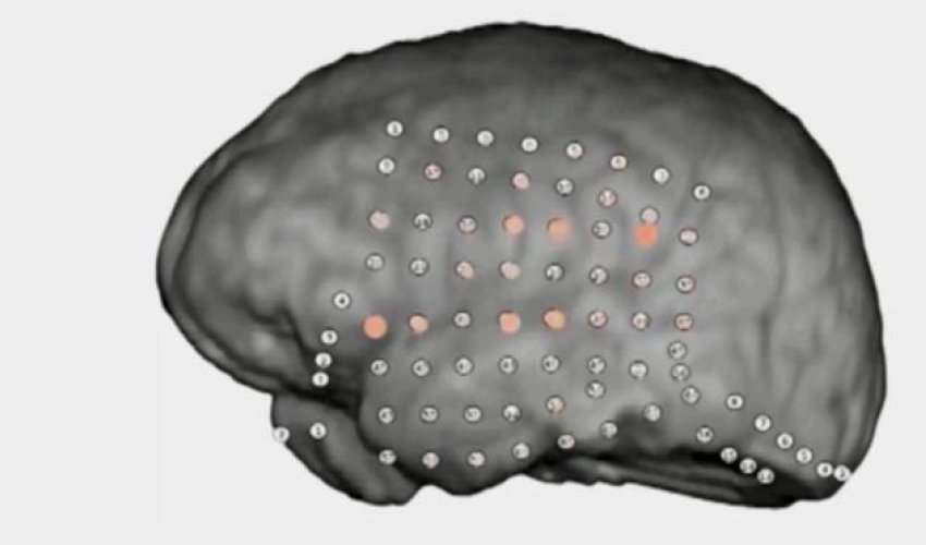 Brain's party noise filter revealed by recordings