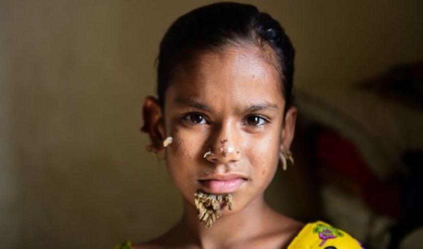 Bangladeshi girl may be first female with 'tree man syndrome' Bangladeshi girl may be first female with 'tree man syndrome'