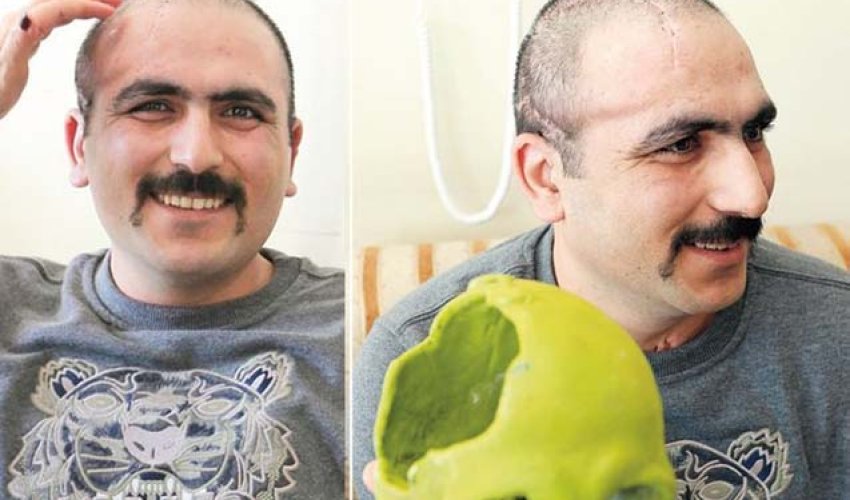 Aprel döyüşündə yaralanan hərbçiyə süni baş qapağı qoyuldu - FOTO Aprel döyüşündə yaralanan hərbçiyə süni baş qapağı qoyuldu - FOTO