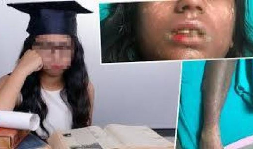 Həkimin yazdığı dərman 15 yaşlı qızcığazı bu hala gətirdi - FOTO