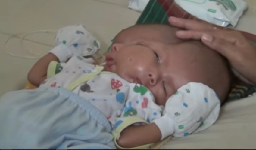 İki üzü olan körpə doğuldu – Video İki üzü olan körpə doğuldu – Video