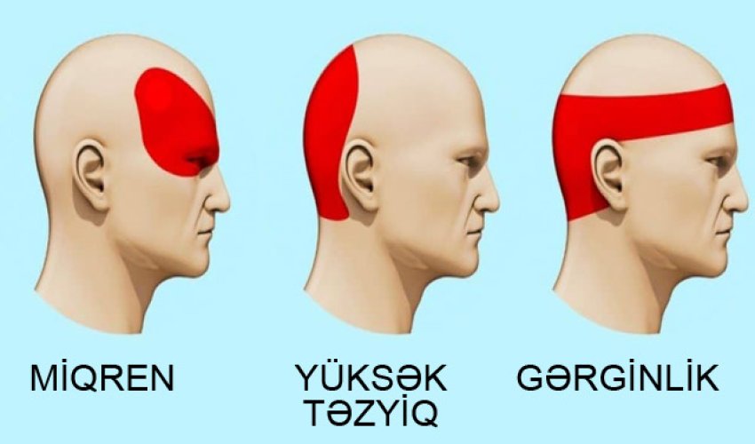 Başınız ağrıyırsa, dərman atmayın, bu çaylardan birini için
