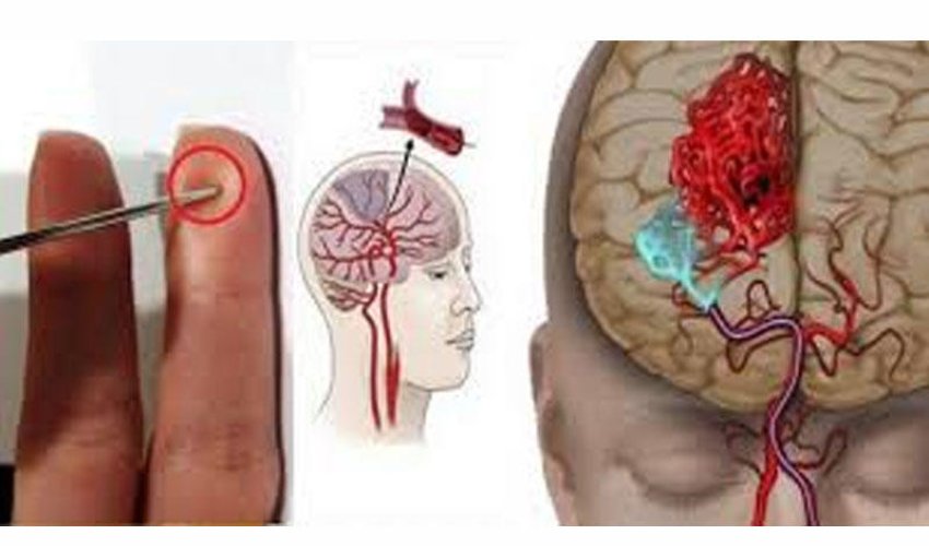 İnsult keçirən xəstəni bu cür xilas edin - Çinli həkimin metodu