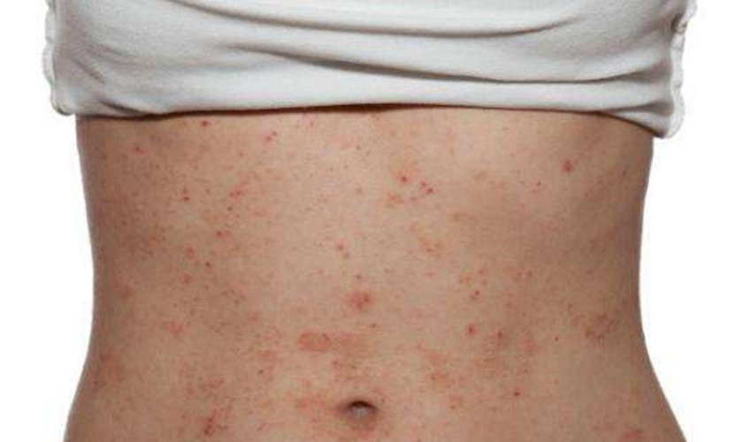 Mədə-bağırsaqdan qaynaqlanan dəri xəstəlikləri - Psoriaz, dermatit, seboreya...
