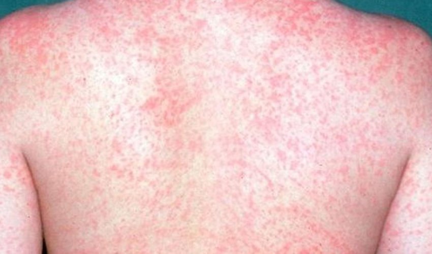 Measles outbreak claims 100 lives in NE Nigeria Measles outbreak claims 100 lives in NE Nigeria