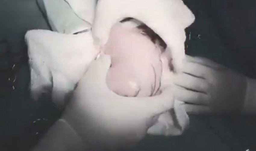 Azərbaycanda 5 yaşlı qızın mədəsindən böyük tük kütləsi çıxarılıb - VİDEO