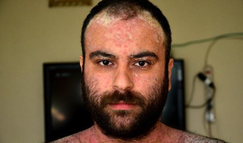 Xəstəliyi səbəbindən evə qapanan gənc - Oturduğu yerə dərisindən qabıqlar tökülür - FOTO