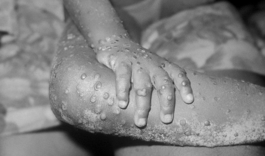 Britaniyada meymunçiçəyinə 200-dən çox yoluxma qeydə alınıb