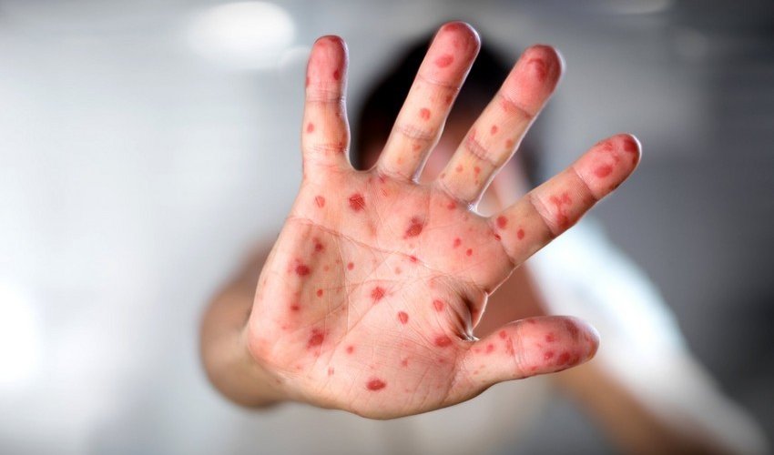 Number of measles patients in Armenia grows to 201 Number of measles patients in Armenia grows to 201
