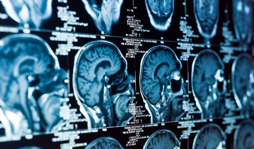 Ученые обнаружили новую причину возникновения болезни Альцгеймера Ученые обнаружили новую причину возникновения болезни Альцгеймера