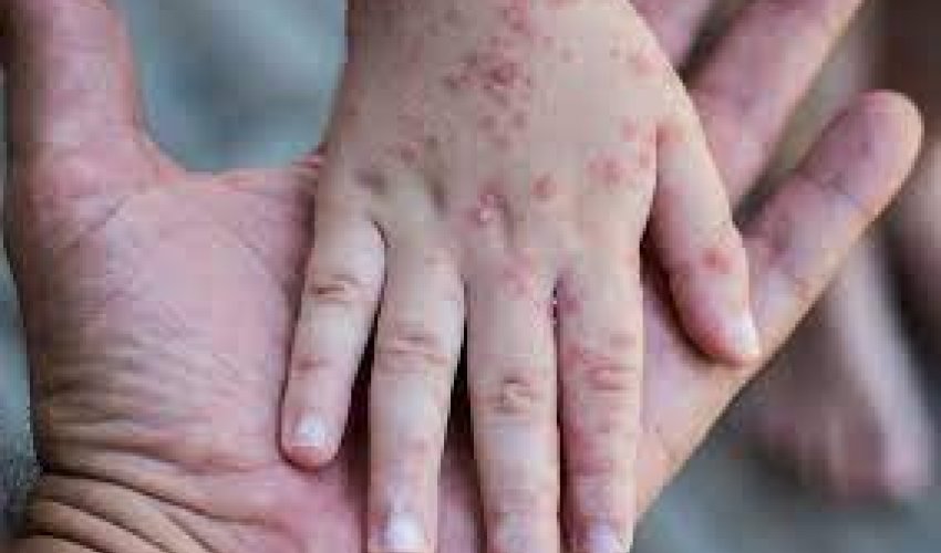 Rumıniyada qızılca epidemiyası təsdiqlənib Rumıniyada qızılca epidemiyası təsdiqlənib