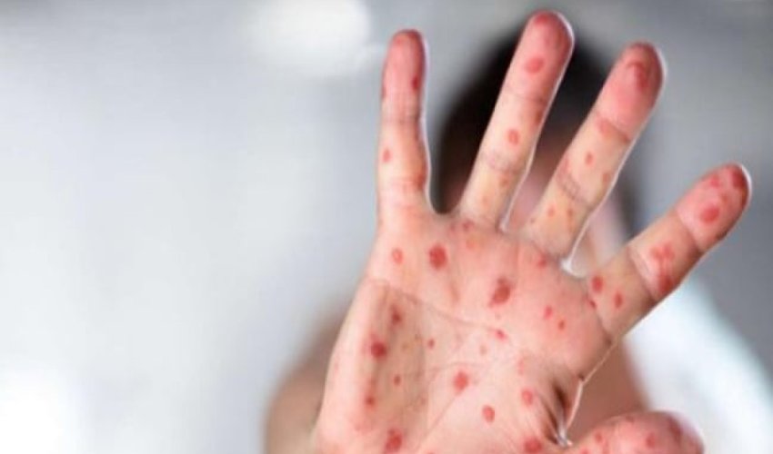 Tovuzda serebral iflic olan azyaşlı qızılcadan ölüb - YENİLƏNİB Tovuzda serebral iflic olan azyaşlı qızılcadan ölüb - YENİLƏNİB