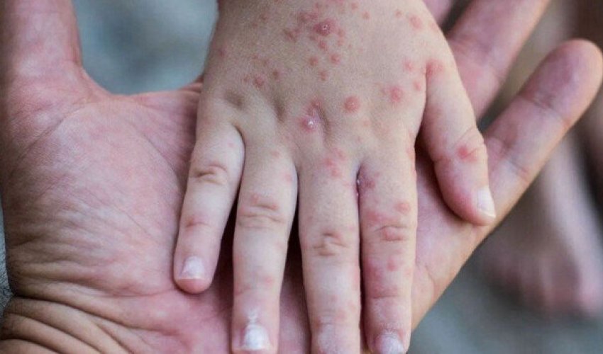 Astarada 6 yaşlı uşaq qızılcadan ölüb Astarada 6 yaşlı uşaq qızılcadan ölüb