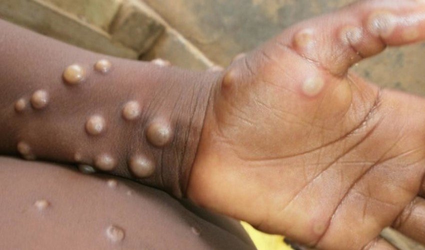 Monkeypox epidemic declared in Congo Monkeypox epidemic declared in Congo