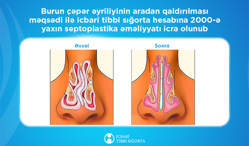 İcbari tibbi sığorta ilə 2000-ə yaxın burun çəpəri əməliyyatı icra olunub