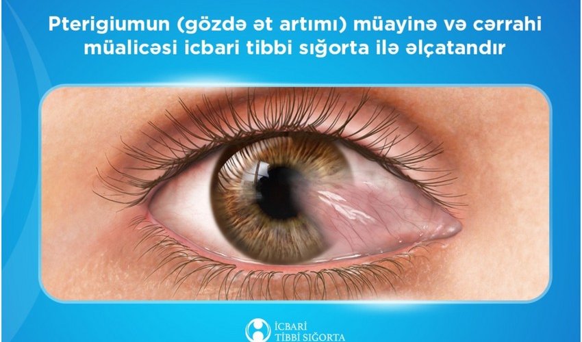 Pterigiumun cərrahi müalicəsi üzrə 2 minə yaxın əməliyyat icra olunub – İTSDA