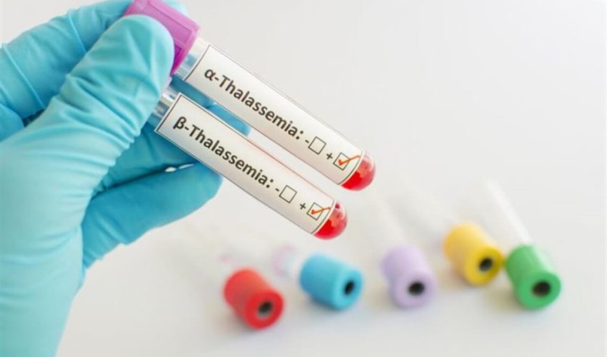 Bəzi talassemiya hallarında yeganə tam müalicə üsulu sümük iliyi transplantasiyasıdır