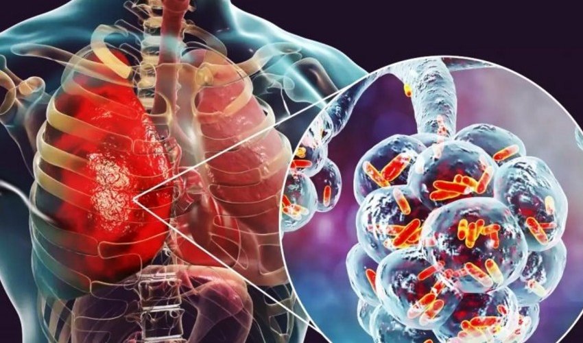 Ötən il pnevmoniyadan ölən şəxslərin sayı açıqlanıb