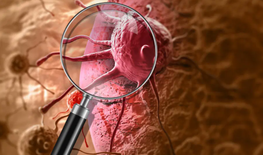 Scientists develop blood test to detect throat cancer years before symptoms