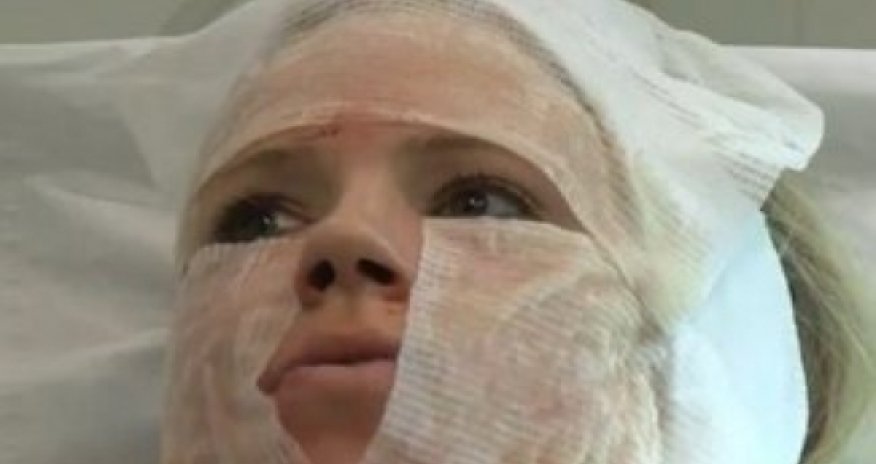 Девушка сделала несколько сотен порезов на лице ради красоты -ВИДЕО