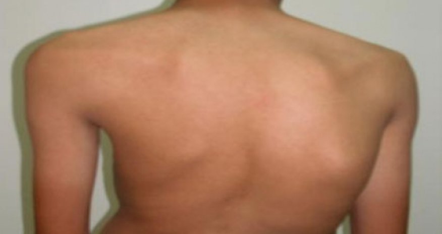 Skolioz xəstələri hərbi xidmətə aparılır?