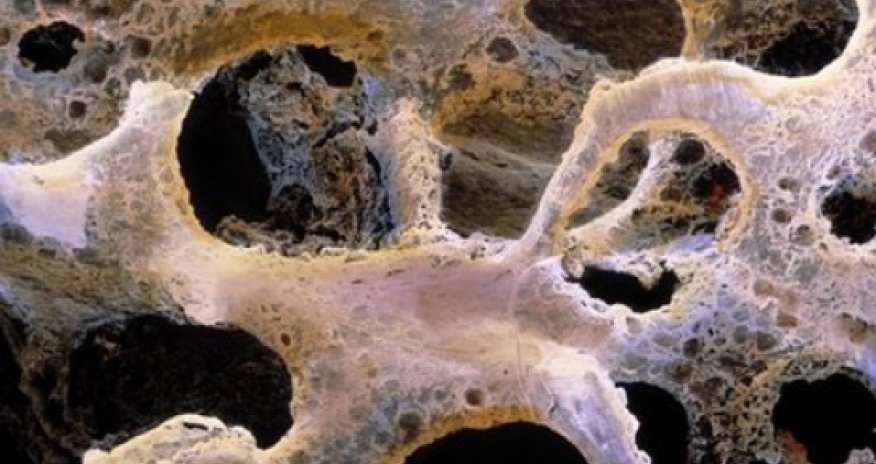 Protein could bring hope to brittle bone disease