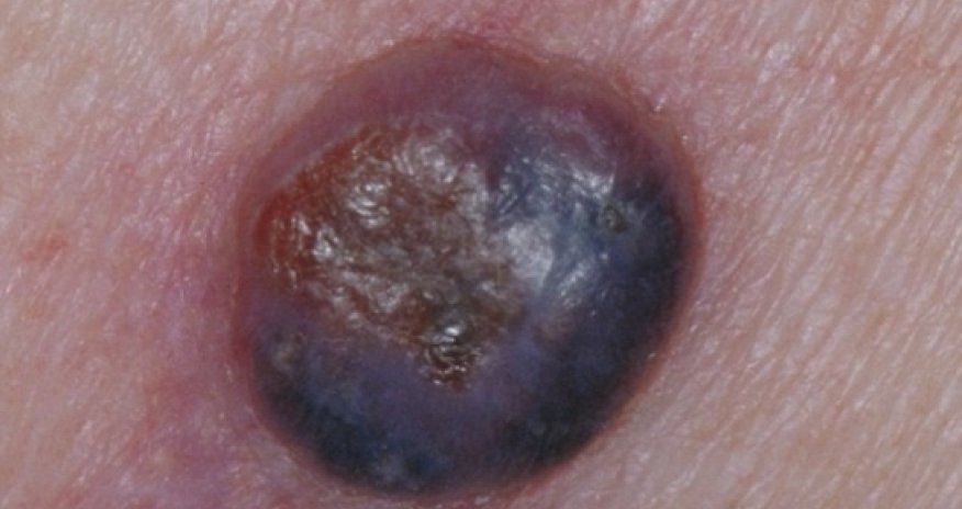 Doctors warn of aggressive form of skin cancer - PHOTO