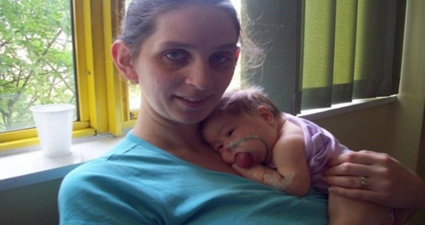 Little girl whose TONGUE wouldn't stop growing - PHOTO