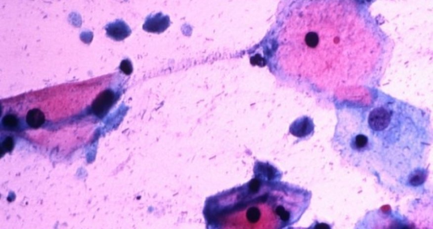 Prostate cancer 'may be a sexually transmitted disease'