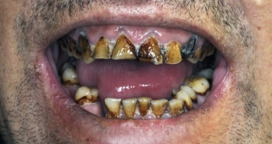 Lasers 'could prevent' need for root canal treatment