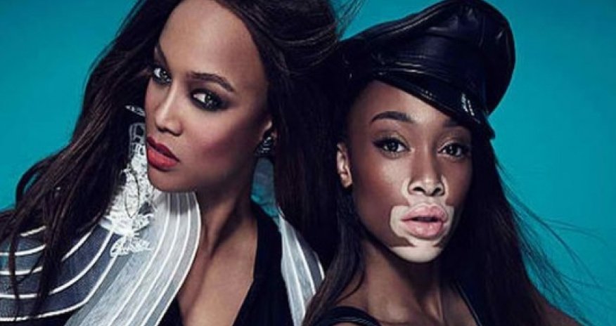 How common is skin pigment condition vitiligo?