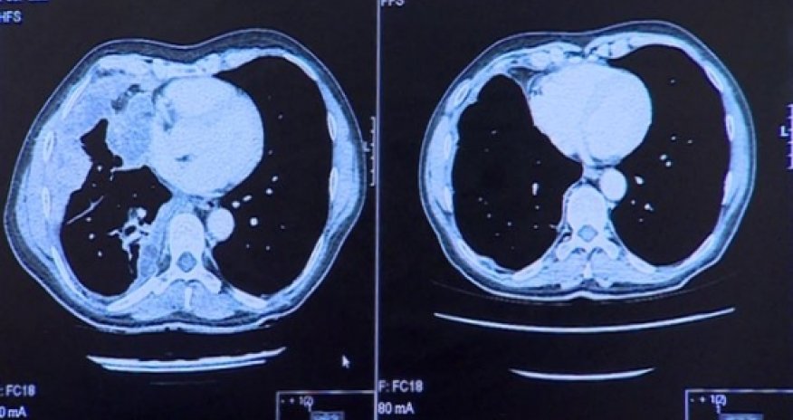 Skin cancer trial results 'exciting'