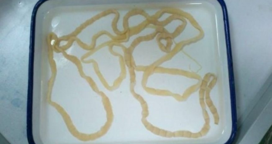 Chinese woman has EIGHT FOOT long tapeworm removed