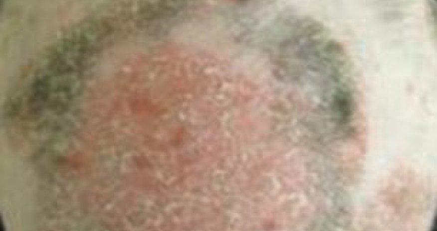 Scientists successfully use arthritis drug to regrow completely bald man's hair - PHOTO