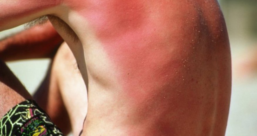 Sunbathing 'may be addictive' warning - PHOTO