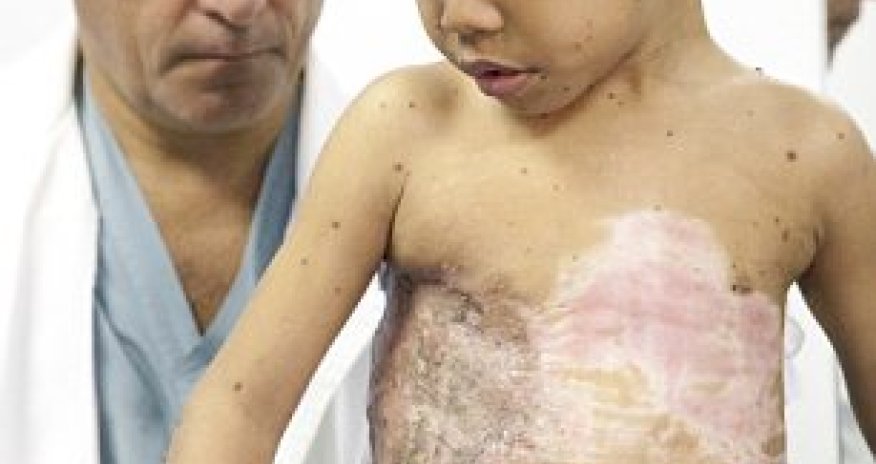 Boy had giant 'turtle shell' mutation removed from his back - PHOTO